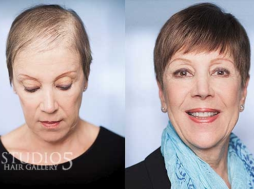 Women's Hair Replacement