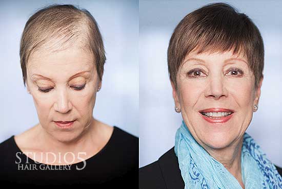 Women's Hair Replacement