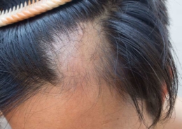 maryland alopecia areata hair loss treatment