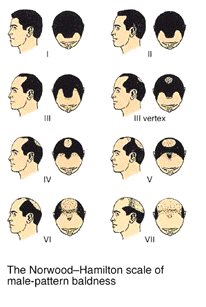 male pattern baldness norwood scale