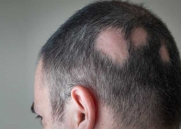Alopecia Areata Hair Loss
